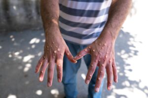 mpox lesions (2)